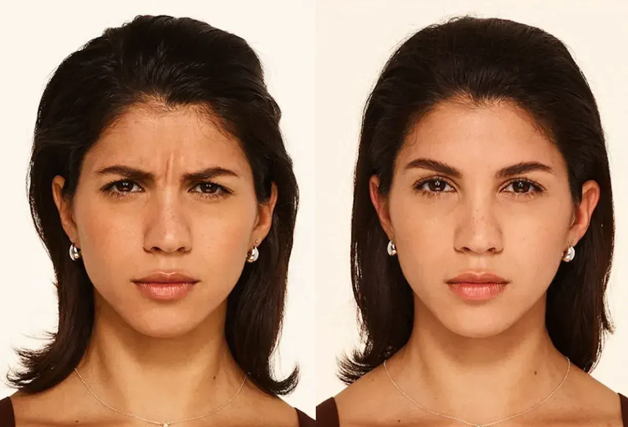 Botox before and after