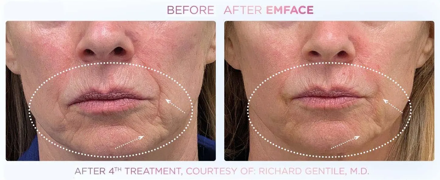 Emface before and after