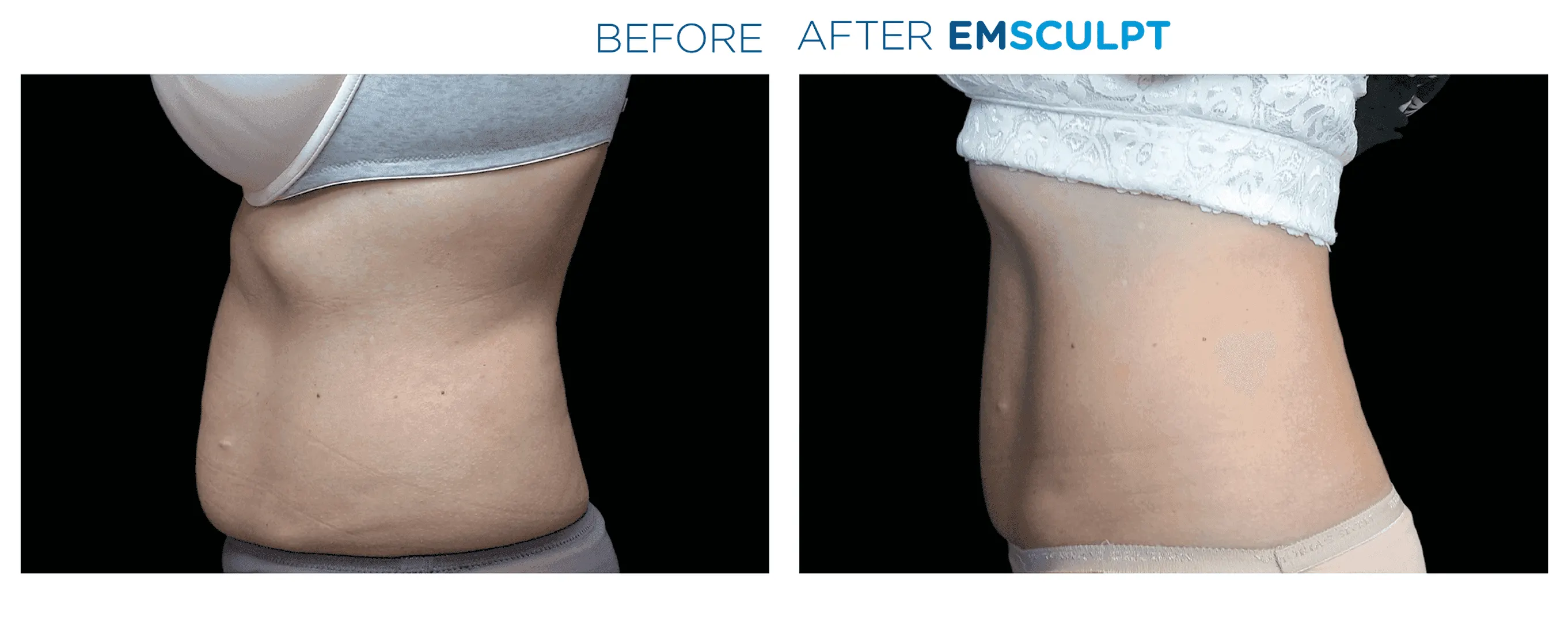 Emsculpt Neo  - Before and After