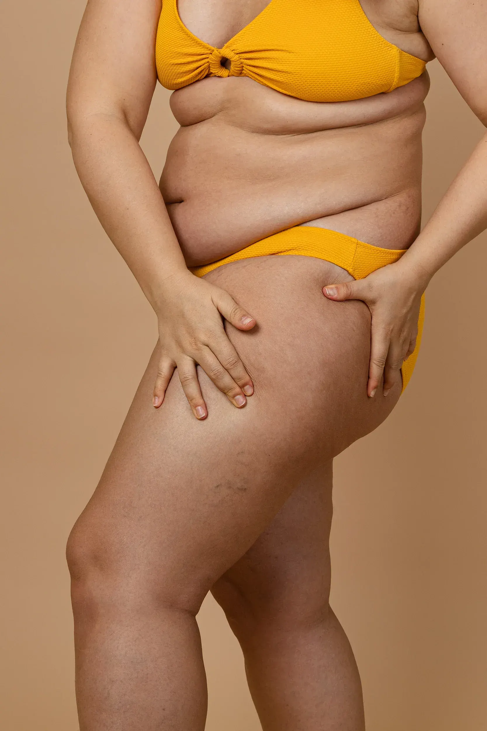What Is Cellulite?