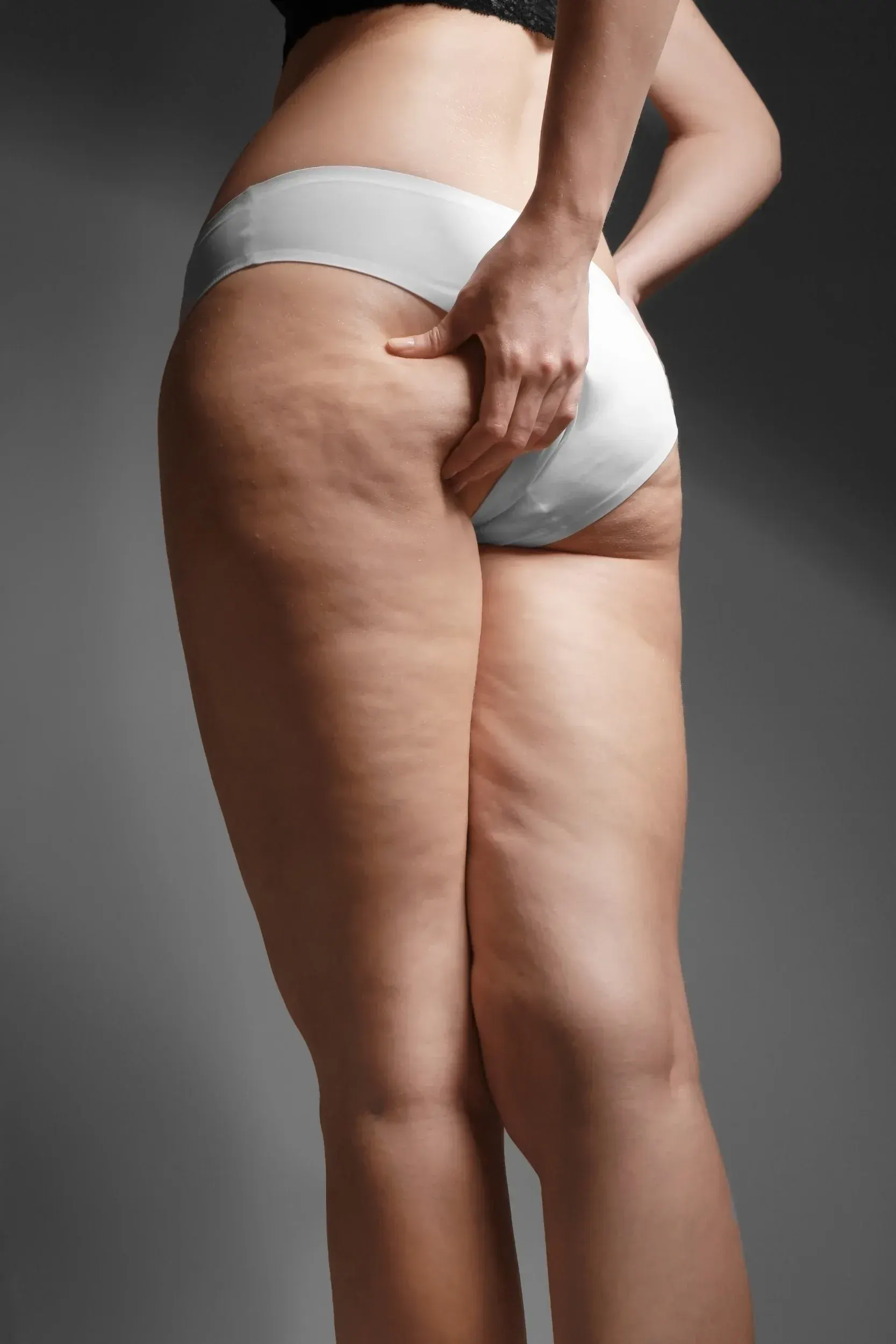 Why Choose Evolving Mind and Body for Cellulite Treatment in Auburndale, FL